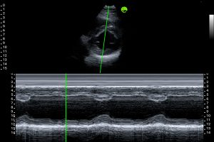 Parasternal short axis view